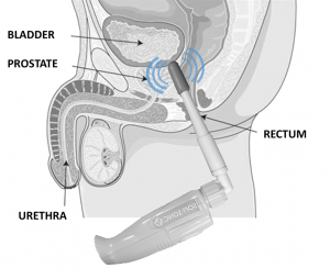 Prostate Massage Improves Blood Flow