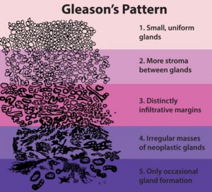 Prostate Gleason Score pic