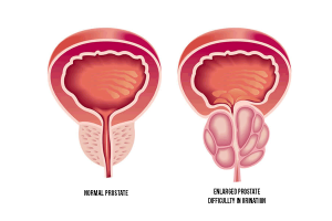 Prostate Infection Natural Treatment