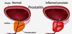 Prostate infection