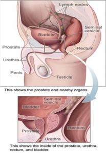 Enlarged Prostate