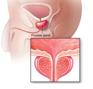 Symptoms of Prostate Problems