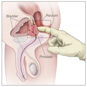 Prostate Screening