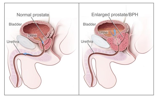 Prostate Volume